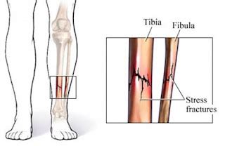 Patah Tulang Kaki - Terapi Sehat : Info Kesehatan Medis dan Alternatif