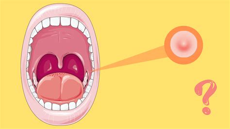 Why do I have a bump on my mouth inside the cheek (pictures)