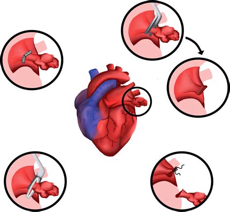 Common techniques for occluding the left atrial appendage. (Center) The... | Download Scientific ...