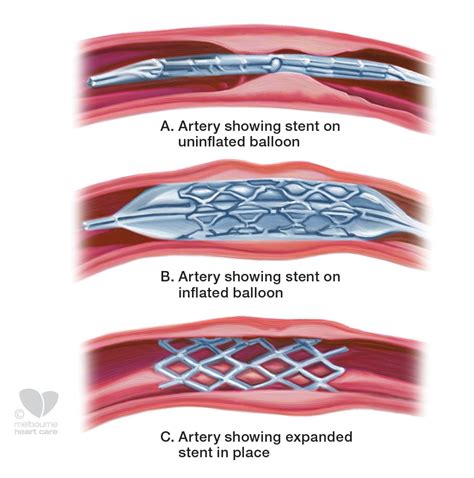 Coronary Stents: Accelerating a Modern Gold Rush? • truPhys