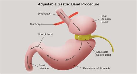 Medical Travel Management: Gastric Sleeve vs Gastric Banding and Bypass ...