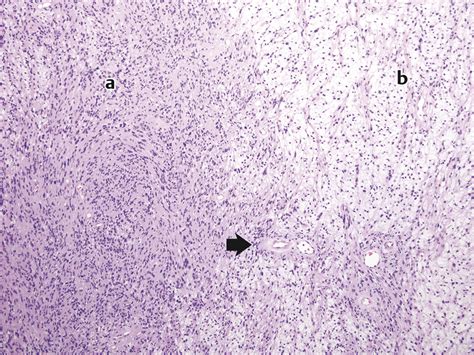 4 Histopathology of Vestibular Schwannoma | Neupsy Key