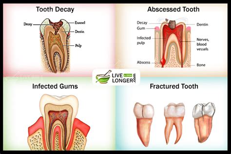 Pain is not Fun for Anyone: Knowing the Possible Causes of Dental Pain is Important in Order to ...