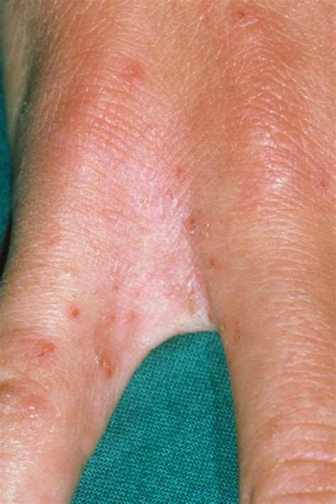 How Do I Get Tested For Scabies?