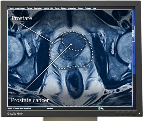 Multiparametric MRI Prostate