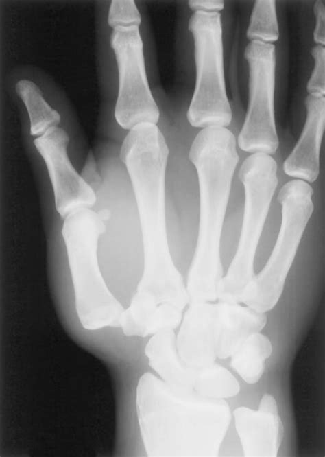 Carpometacarpal Joint Dislocation