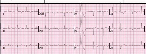 Dr. Smith's ECG Blog: Wellens' missed. Then returns with Wellens' with ...