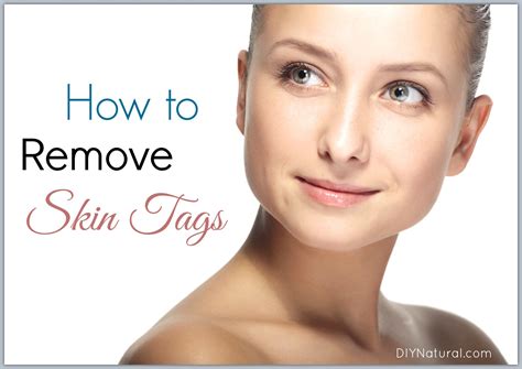 How to Remove Skin Tags: 5 Ways to Get Rid of Them Naturally