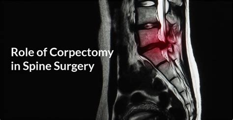 Role of Corpectomy in Spine Surgery