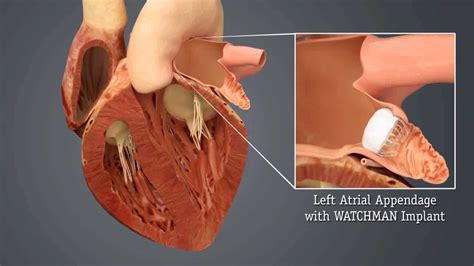 Left Atrial Appendage Occlusion (LAAO) | STROKE MANUAL