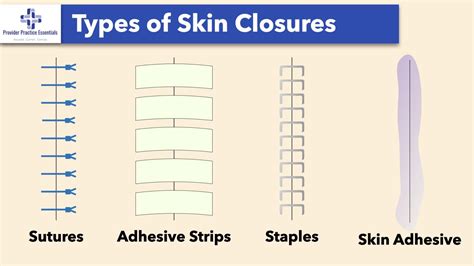 Wound Closure Techniques