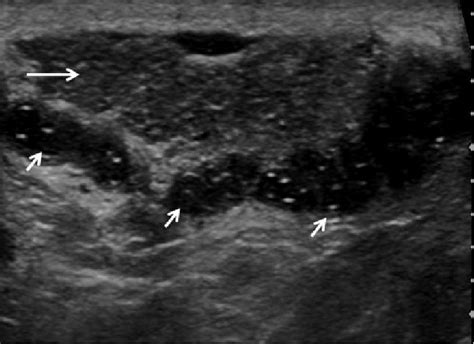 Longitudinal ultrasound of the epididymis demonstrating the classical... | Download Scientific ...