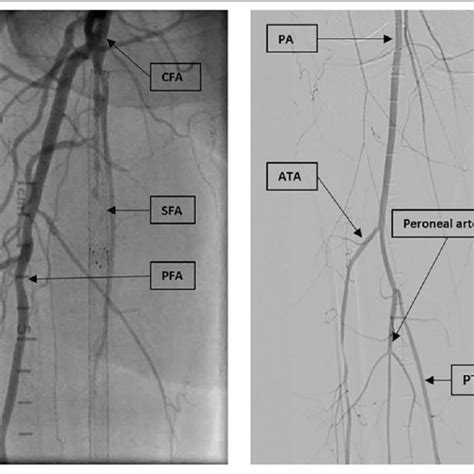 Peripheral angiogram of the right lower extremity. ATA indicates... | Download Scientific Diagram