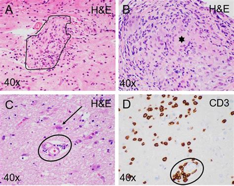 Neursarcoidosis and sarcoidosis histology. Sarcoidosis histology. (A ...