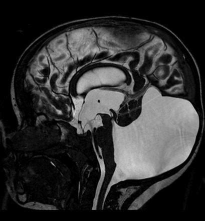 Dandy Walker Syndrome Mri