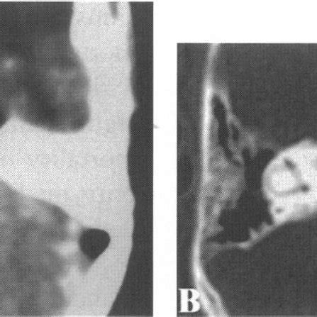 Case 2 (K.B.). (A) The empty delta sign is seen on the left side with a ...