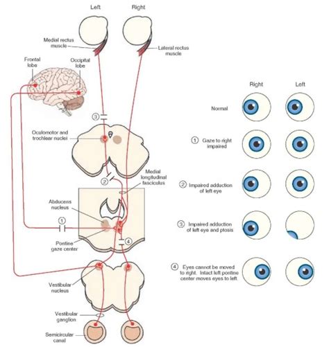 Looking to the right voluntarily: cortical gaze... | USMLE notebook