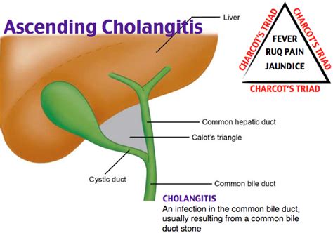 Cholangitis