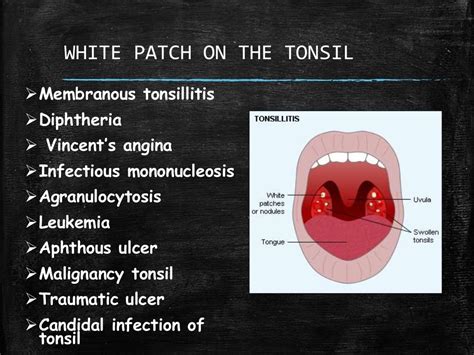 White patch on the tonsil – differential diagnosis