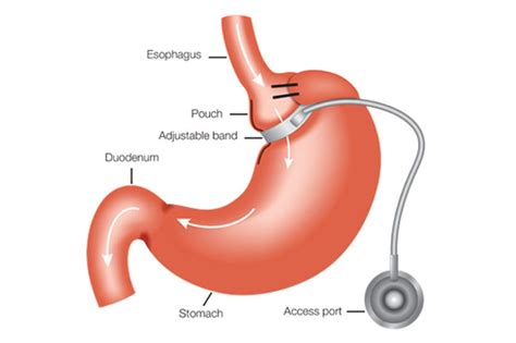 adjustable-gastric-banding - DSSurgery