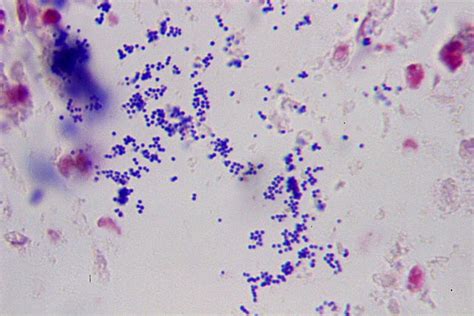 Sputum Definition, Classification & Culture | Study.com