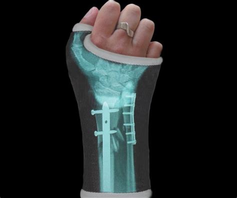 30 Creative Cast Designs That Prove You Can Still Look Cool With An Injury