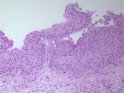 Low-grade non-invasive papillary urothelial carcinoma containing ...