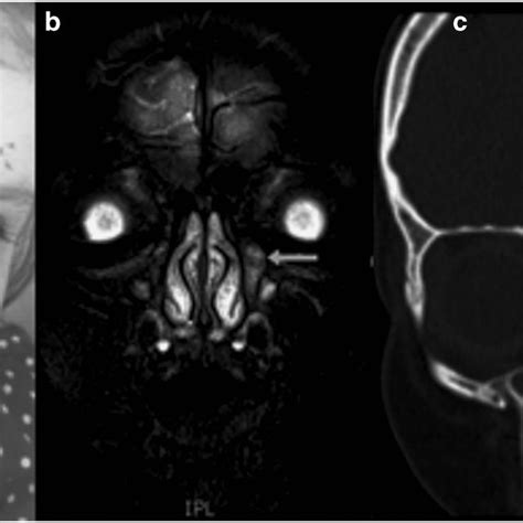 (a) Clinical photograph of left lower lid abscess. (b)... | Download Scientific Diagram