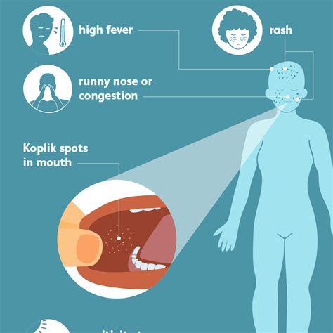 Measles: Signs, Symptoms, and Complications