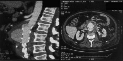 CT scan with delayed contrast medium, at the time of rupture ...