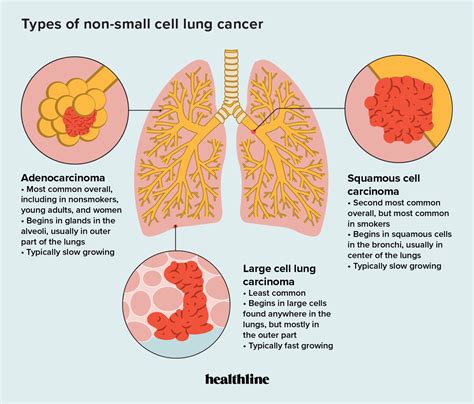 Types of Non-Small Cell Lung Cancer: Causes, Treatment, and Outlook