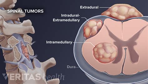 Spinal Tumors and Sciatica Symptoms | Spine-health