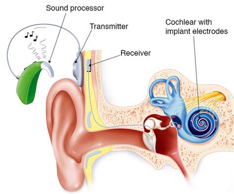 Cochlear implant function, surgery and cochlear implant pros and cons