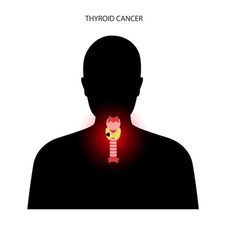 Premium Vector | Thyroid cancer stages