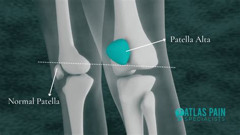 Possible Causes And Treatment Of Patella Alta - Atlas Pain Specialists