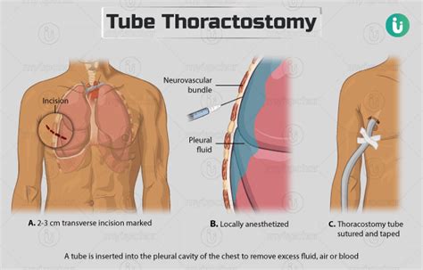 Chest Tube Insertion