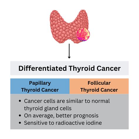 What Does it Mean to have “Differentiated Thyroid Cancer”? – Qualisure