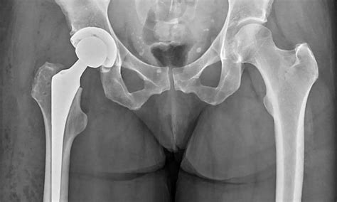 Hip X-rays helpful for osteoporosis screening in total hip arthroplasty patients