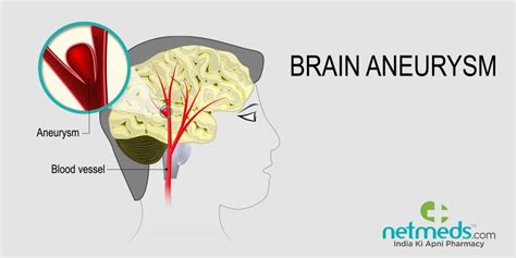 Brain Aneurysm: Causes, Symptoms And Treatment