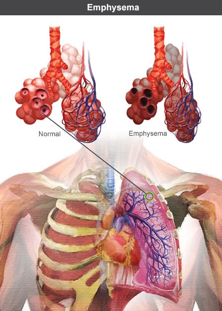 Emphysema: Clinical Features | RESPe