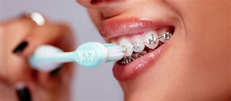 Baldwin Park Dental Center - Care Following Orthodontics – Retainers