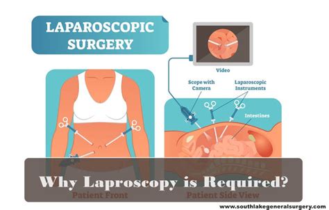 Laparoscopic Surgery and Recovery - Southlake General Surgery