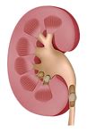 Kidney Stones | Mysite