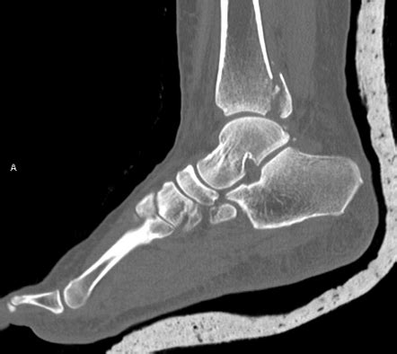 Posterior malleolus fracture | Radiology Reference Article | Radiopaedia.org