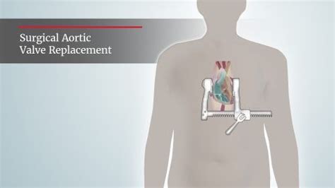 Surgical aortic valve replacement through open heart surgery