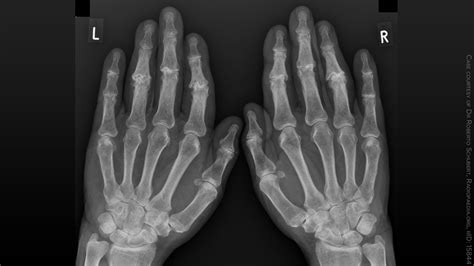 Rheumatoid Arthritis Hands X Ray