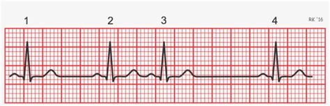 Download Electrocardiogram Rhythm Strip - Irregular Heart Rate Ecg - HD Transparent PNG ...