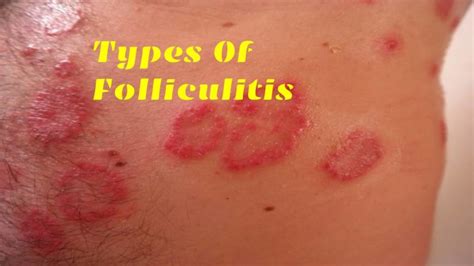 Folliculitis: What Is Folliculitis? Its Symptoms, Causes, And More