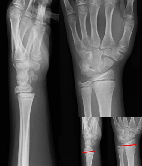 Salter Harris Fracture Treatment | Salter Harris Surgery