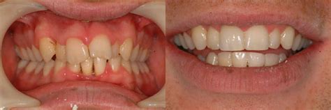 Inman Aligner Before and After – What A Difference 12 weeks Makes | Blog